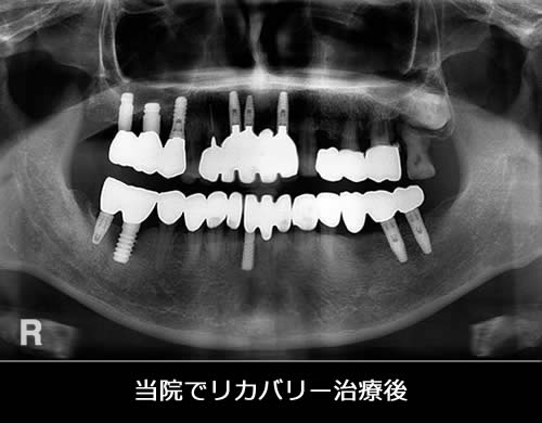 当院でリカバリー治療後