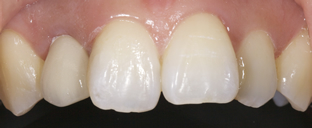 審美的な治療で白く美しい歯に